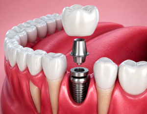 Dental Implants in Anna Nagar