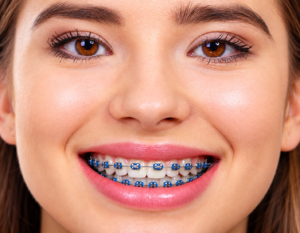 Braces Treatment in Madurai
