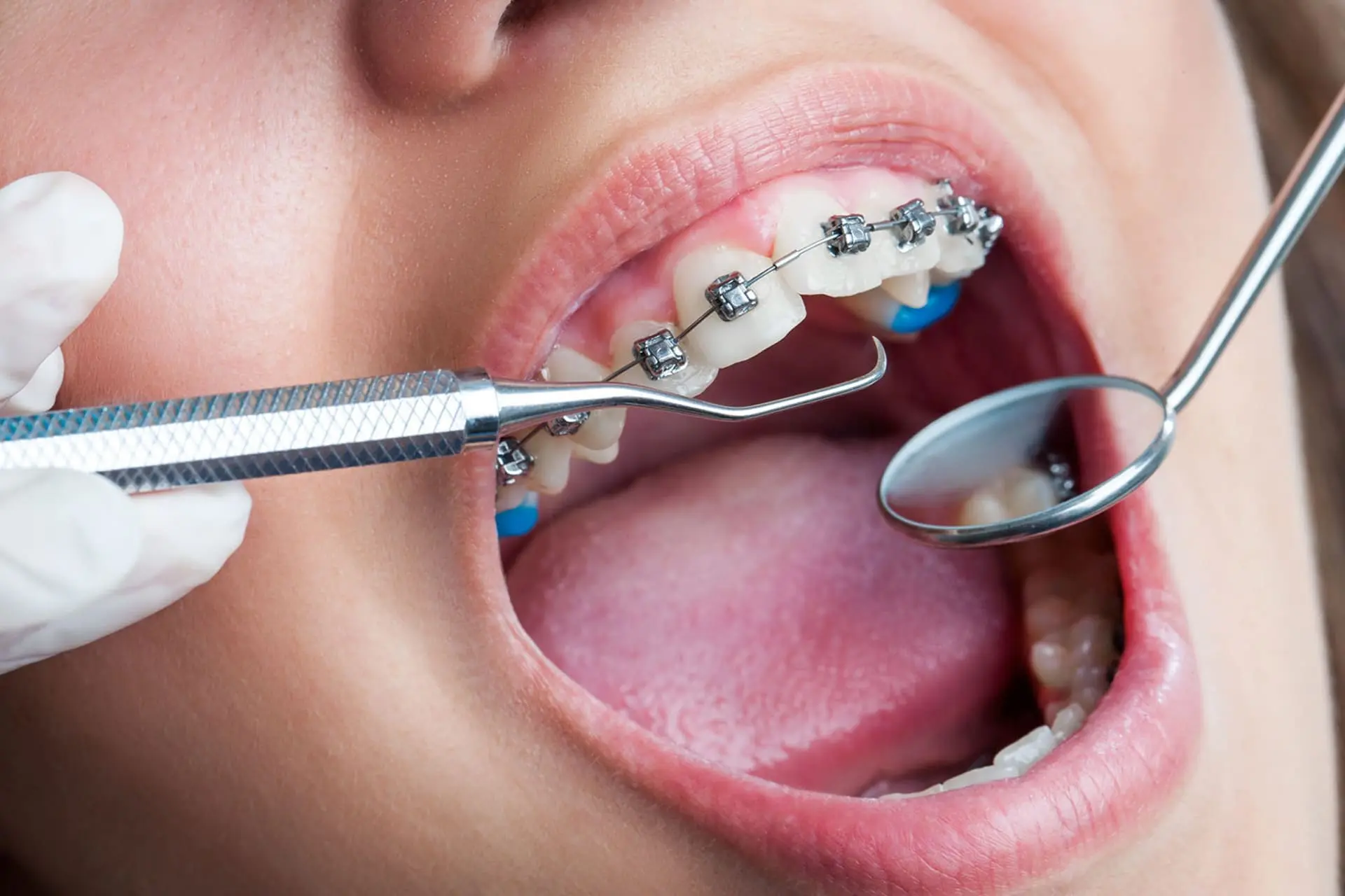 braces-in-madurai
