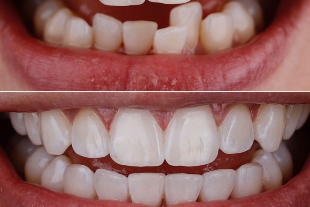 teeth-alignment