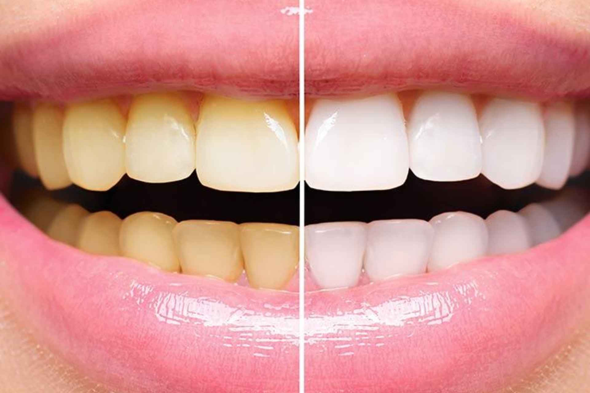 teeth-whitening-1