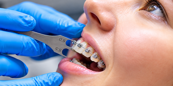 braces-blog2