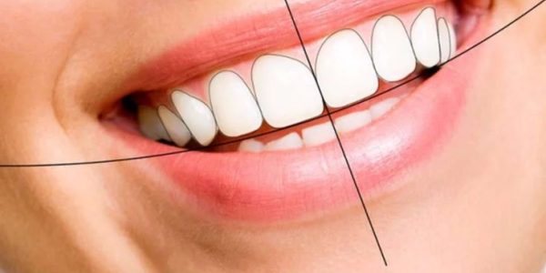 smile-design-1